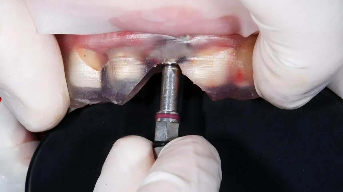 Inserimento di impianto dentale con guida chirurgica in fase operativa